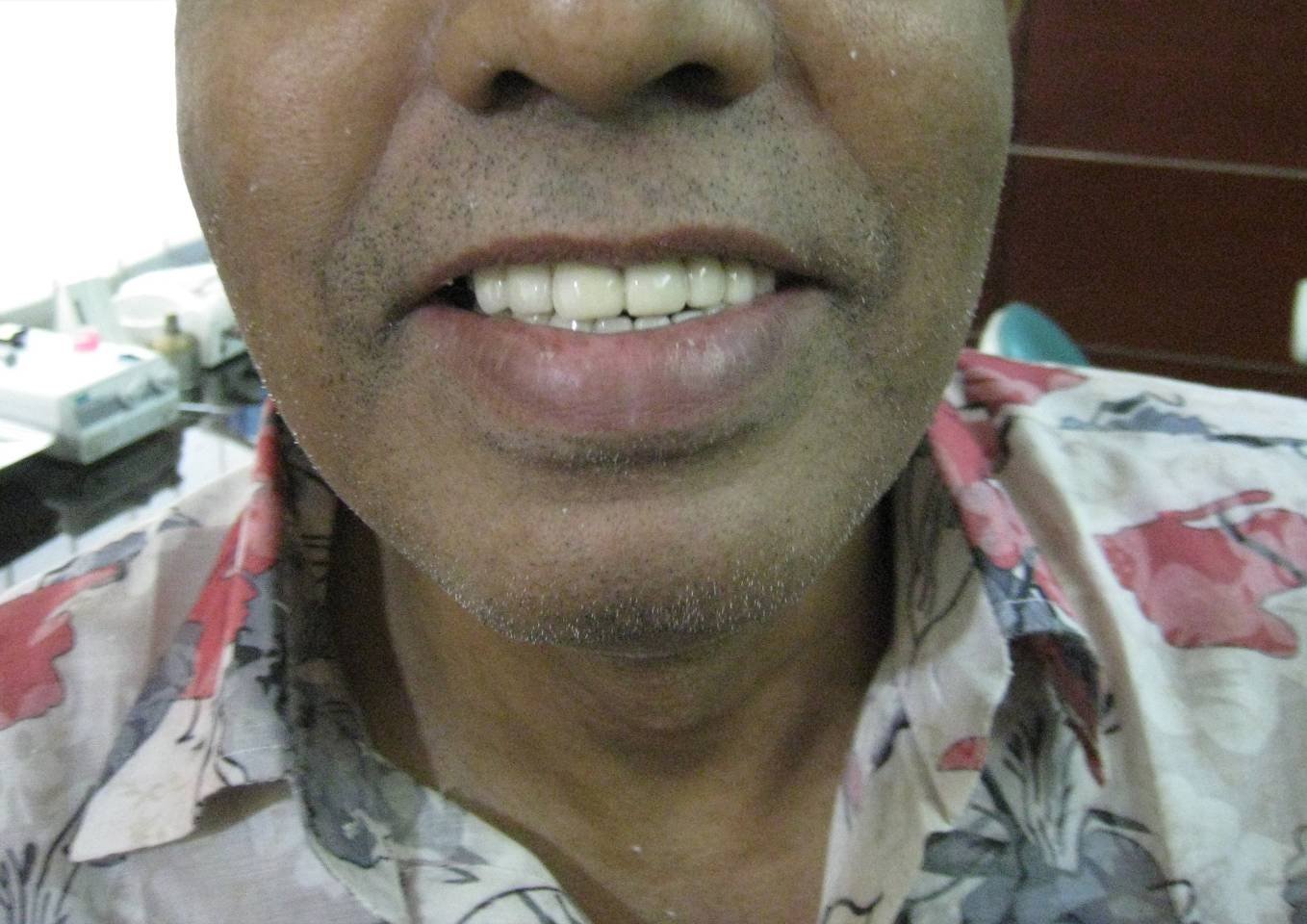 Gapped Teeth After - Patient 8