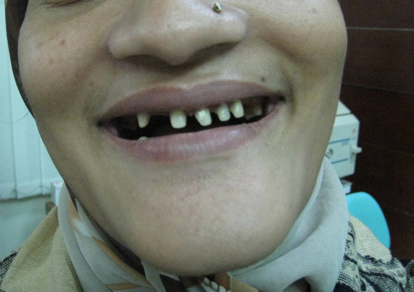 Gapped Teeth Before - Patient 2