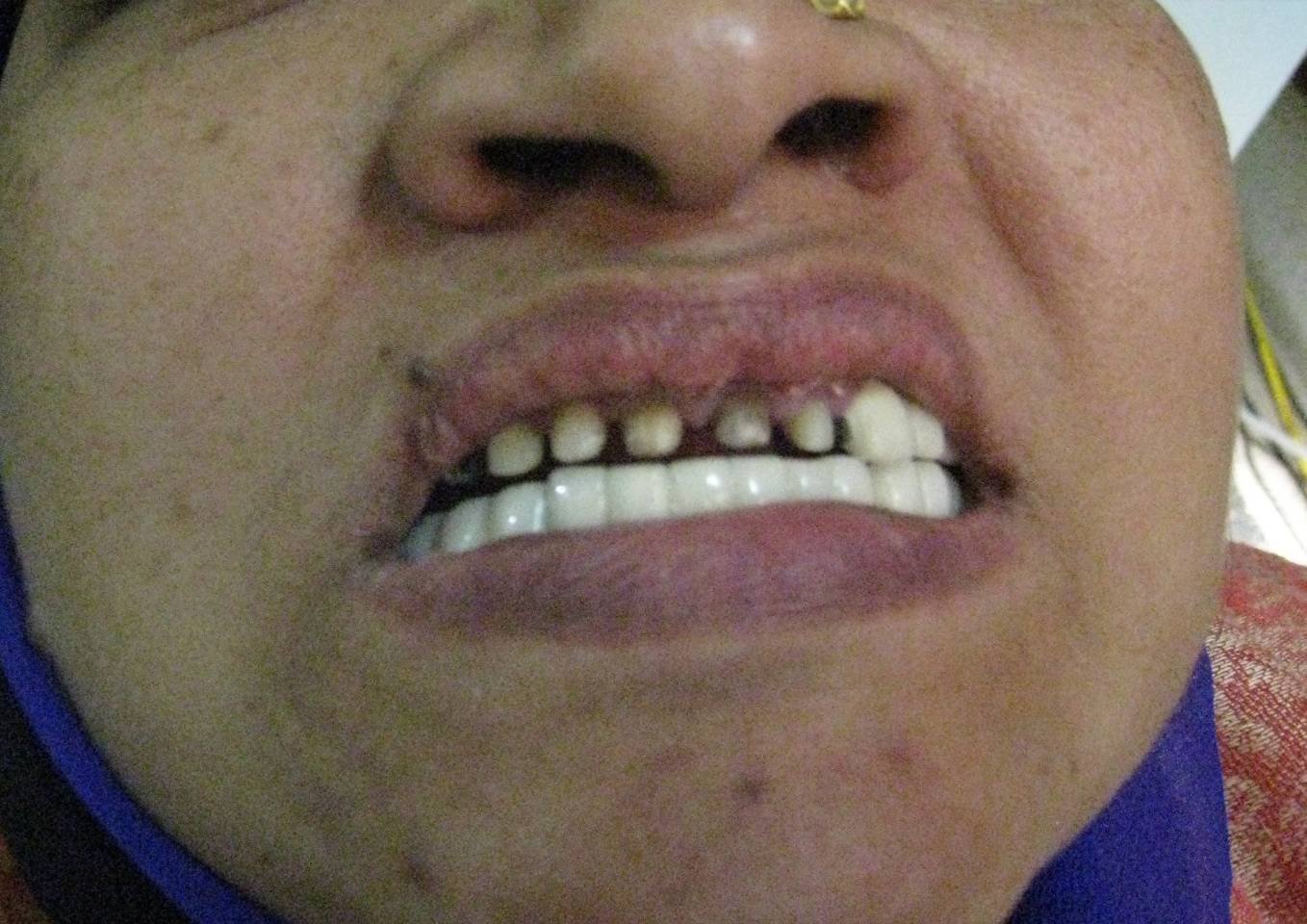 Gapped Teeth Before - Patient 1