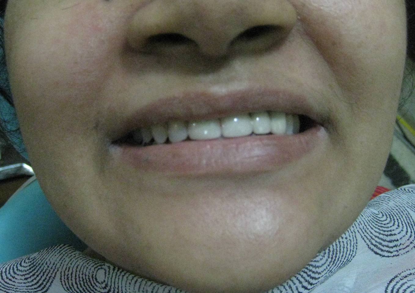 Gapped Teeth After - Patient 3