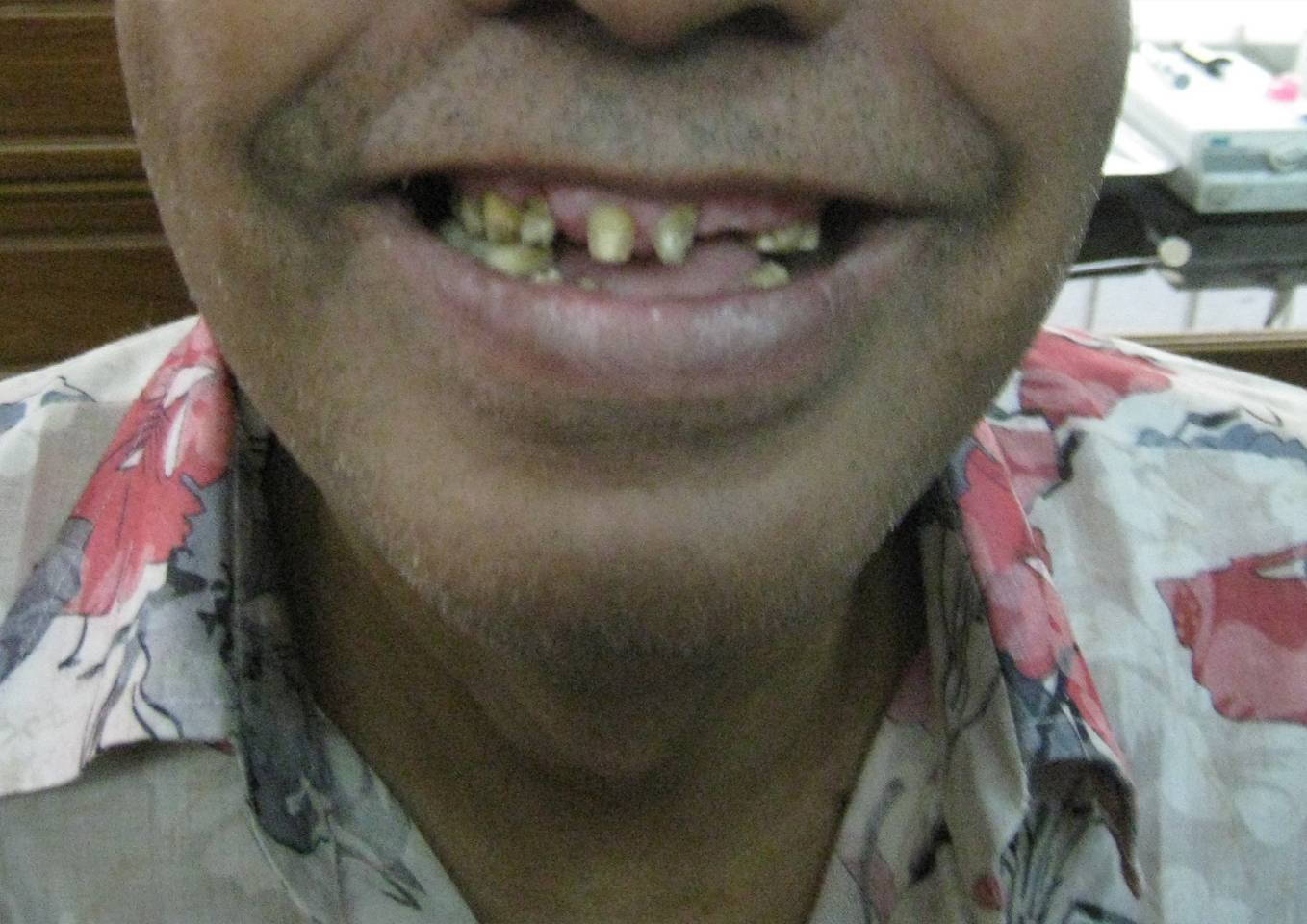 Gapped Teeth Before - Patient 8