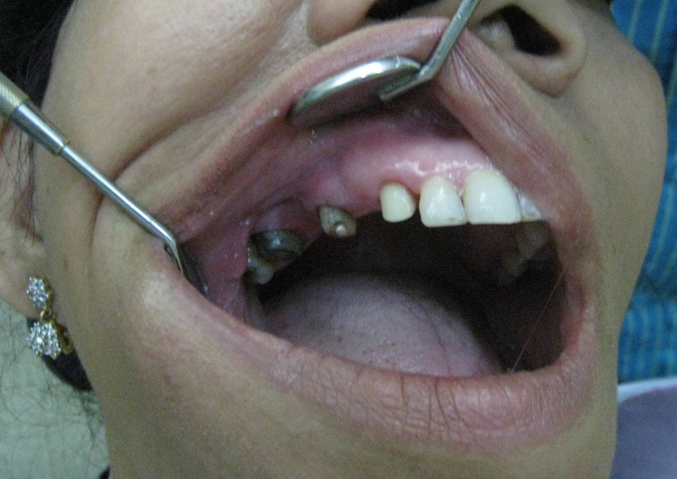 Gapped Teeth Before - Patient 7