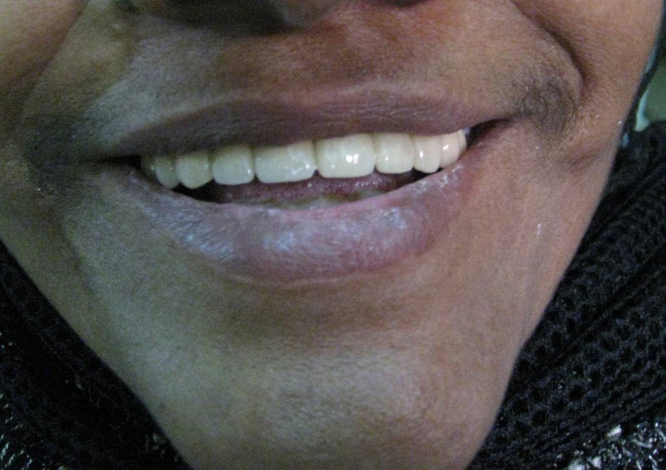 Gapped Teeth After - Patient 6