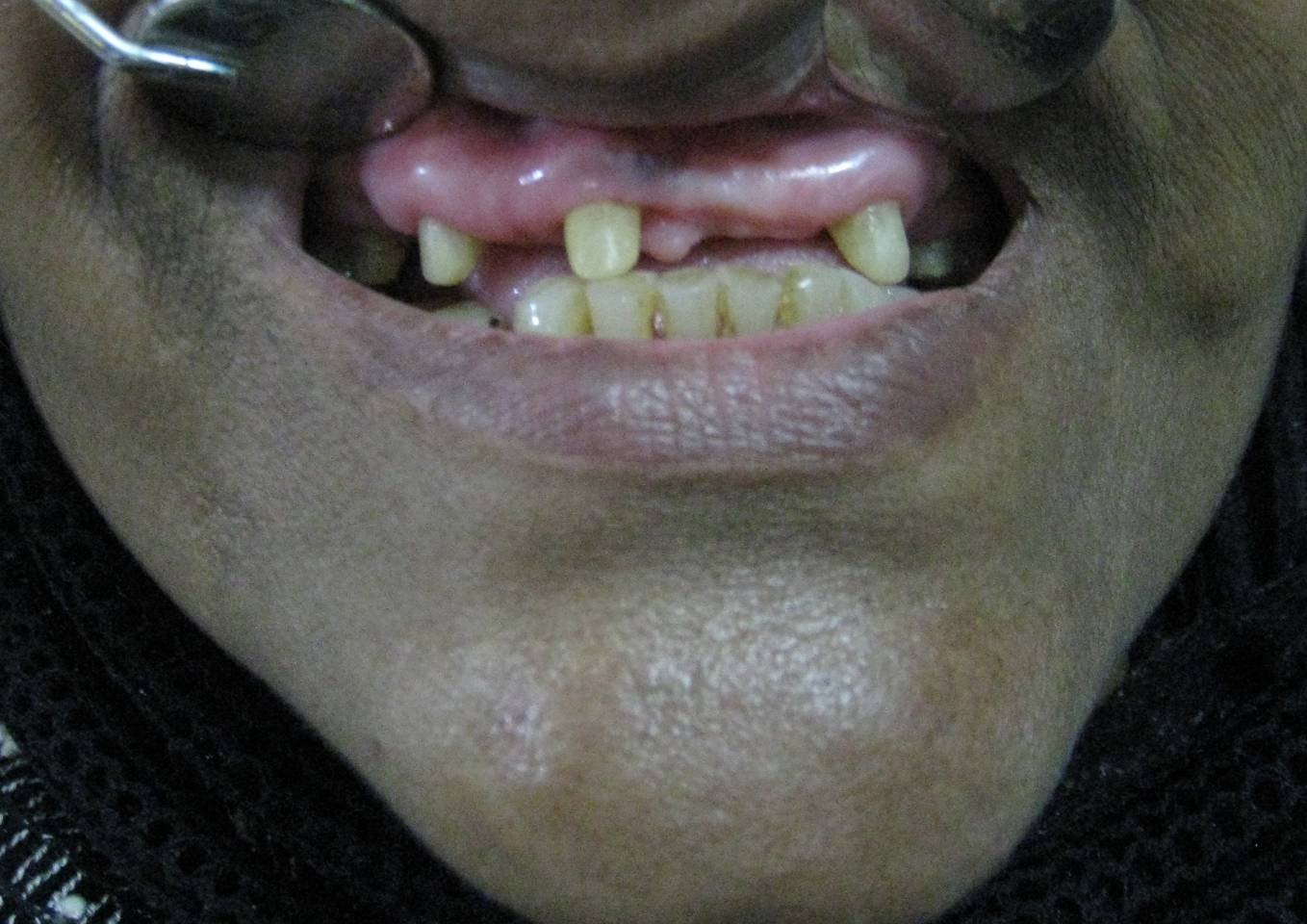 Gapped Teeth Before - Patient 6