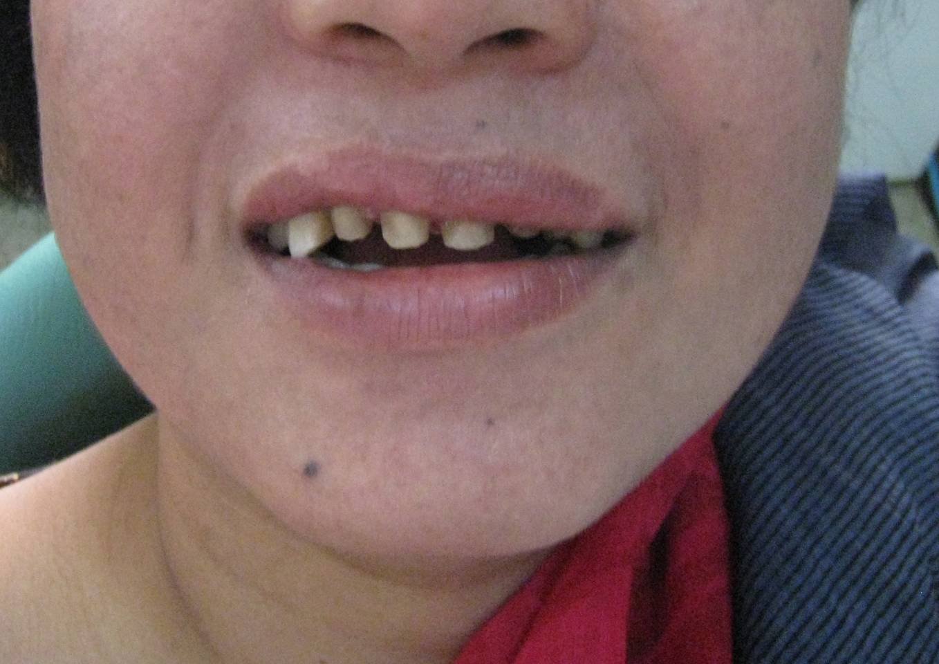 Gapped Teeth Before - Patient 5