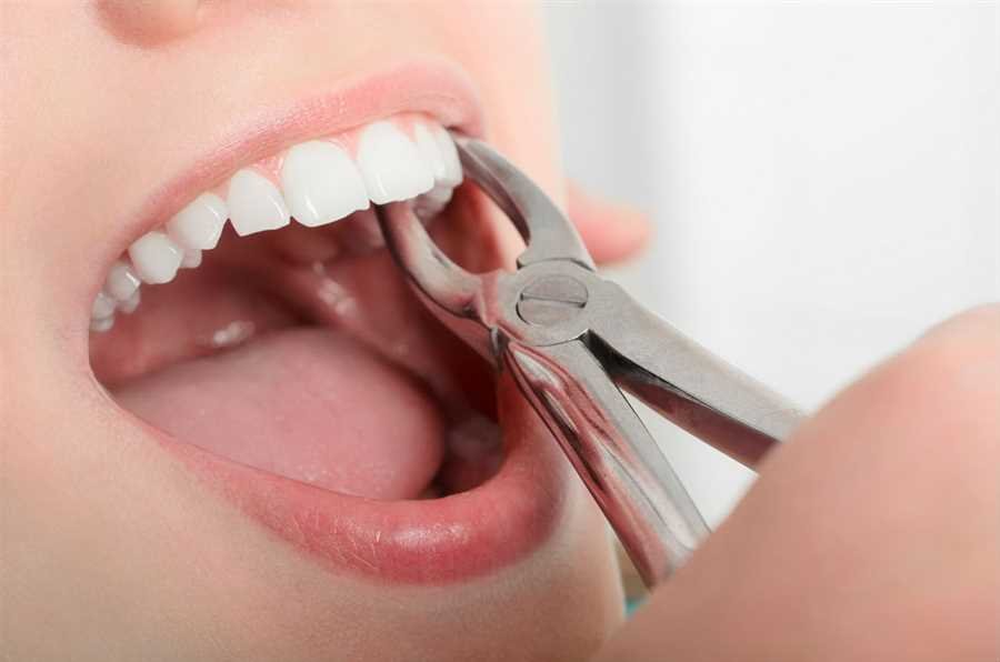 Tooth Extraction Guide